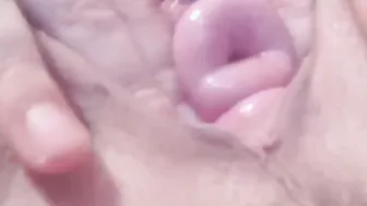 Cervix performance plowed and pump