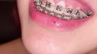 SLUTS WITH BRACES SHOWS HER MOUTH INTO ASMR