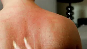 Red Marks After Back Scratching