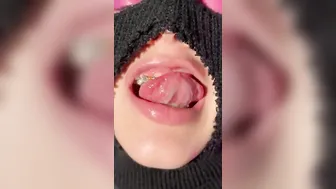 My new metal mouth