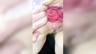 Grosse balles dans mon enorme trou du cul avec prolapse